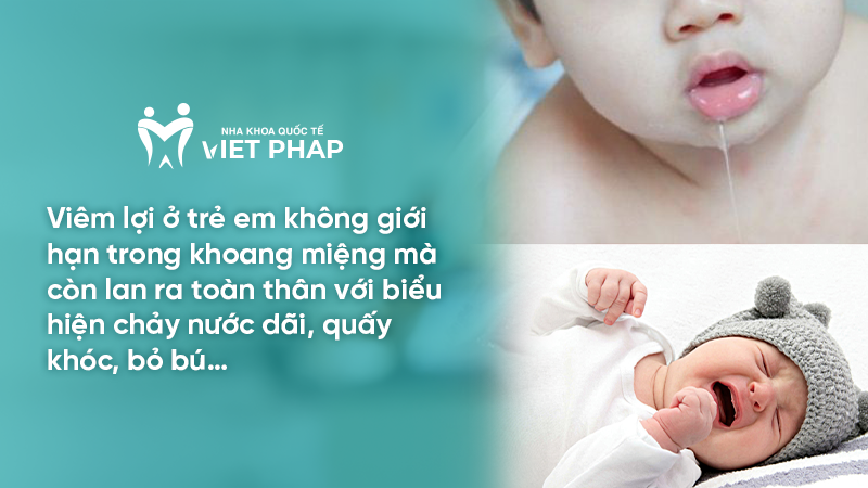 Viêm lợi ở trẻ em không giới hạn trong khoang miệng mà còn lan ra toàn thân với biểu hiện chảy nước dãi, quấy khóc, bỏ bú…