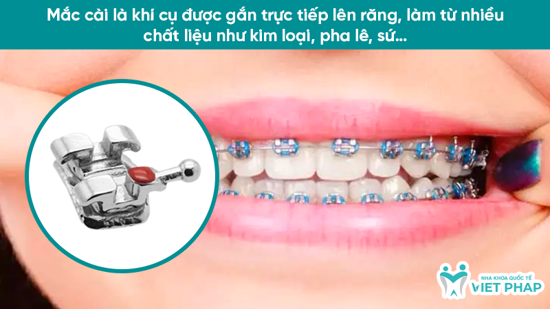 Mắc cài là khí cụ được gắn trực tiếp lên răng, làm từ nhiều chất liệu như kim loại, pha lê, sứ…