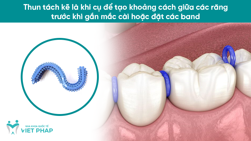 Thun tách kẽ là khí cụ để tạo khoảng cách giữa các răng trước khi gắn mắc cài hoặc đặt các band