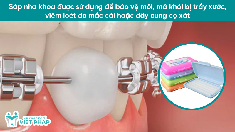 Sáp nha khoa được sử dụng để bảo vệ môi, má khỏi bị trầy xước, viêm loét do mắc cài hoặc dây cung cọ xát
