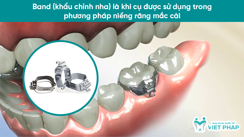 Band (khẩu chỉnh nha) là khí cụ được sử dụng trong phương pháp niềng răng mắc cài