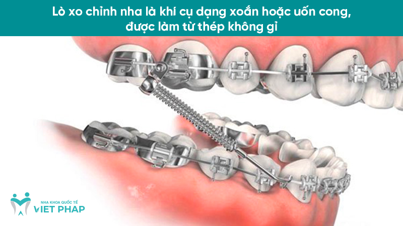 Lò xo chỉnh nha là khí cụ dạng xoắn hoặc uốn cong, được làm từ thép không gỉ