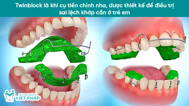 Twinblock là khí cụ tiền chỉnh nha, được thiết kế để điều trị sai lệch khớp cắn ở trẻ em