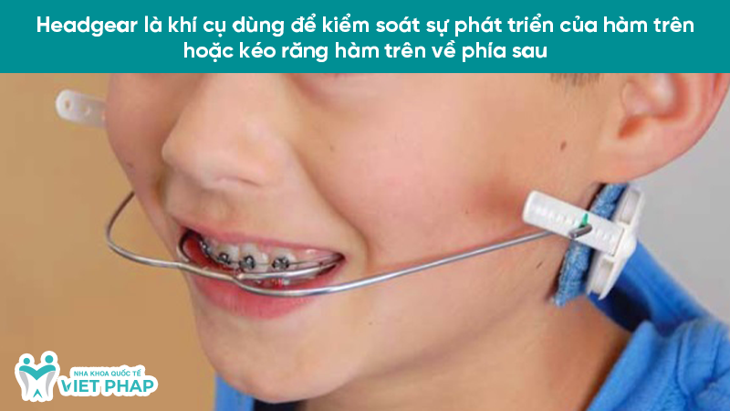 Headgear là khí cụ dùng để kiểm soát sự phát triển của hàm trên hoặc kéo răng hàm trên về phía sau