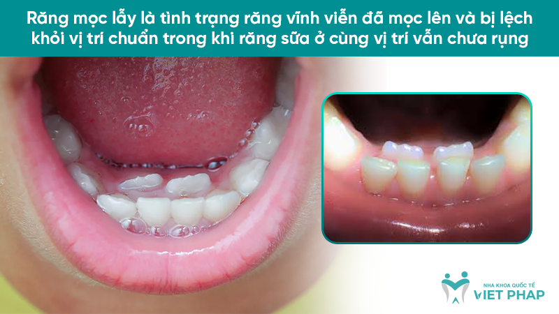 rang moc lay 1 Răng mọc lẫy là tình trạng răng vĩnh viễn đã mọc lên và bị lệch khỏi vị trí chuẩn trong khi răng sữa ở cùng vị trí vẫn chưa rụng