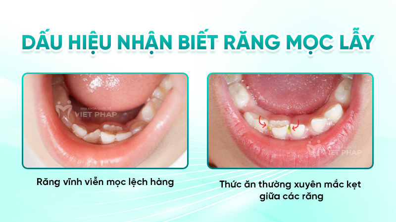 rang moc lay 3 Dấu hiệu nhận biết răng mọc lẫy
