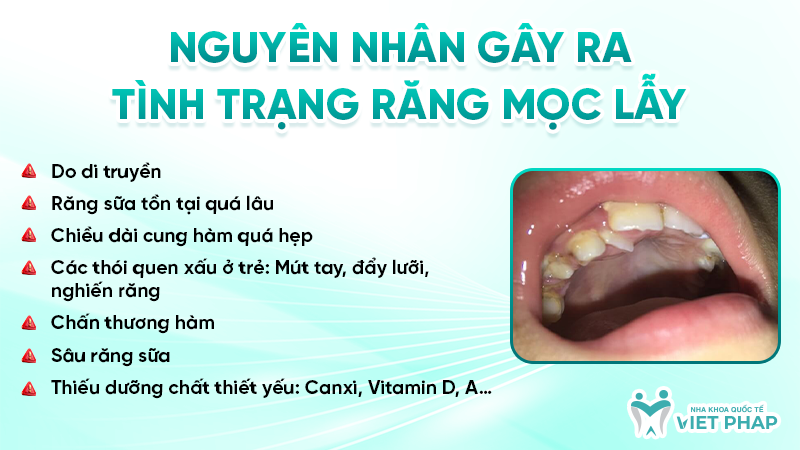 rang moc lay 4 Nguyên nhân gây ra tình trạng răng mọc lẫy
