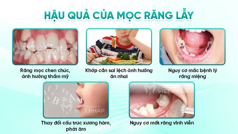 rang moc lay 5 Hậu quả của mọc răng lẫy