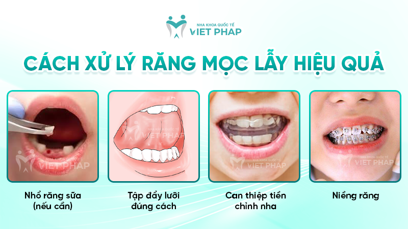 rang moc lay 6 Cách xử lý răng mọc lẫy hiệu quả