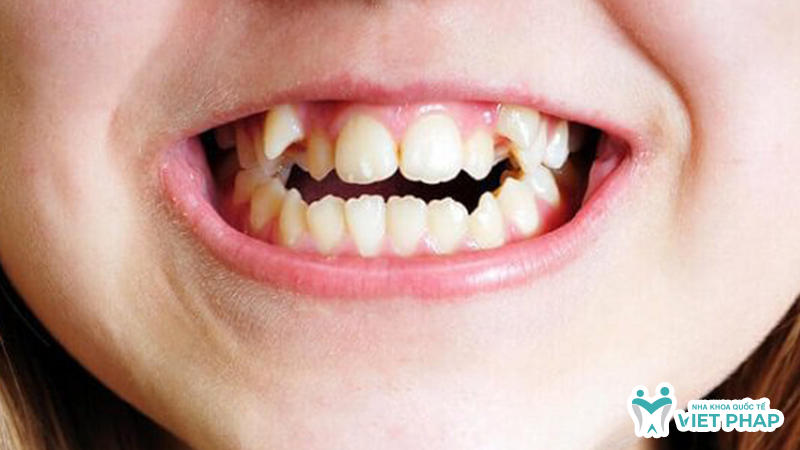 rang moc lay 8 Răng mọc lệch ra phía ngoài