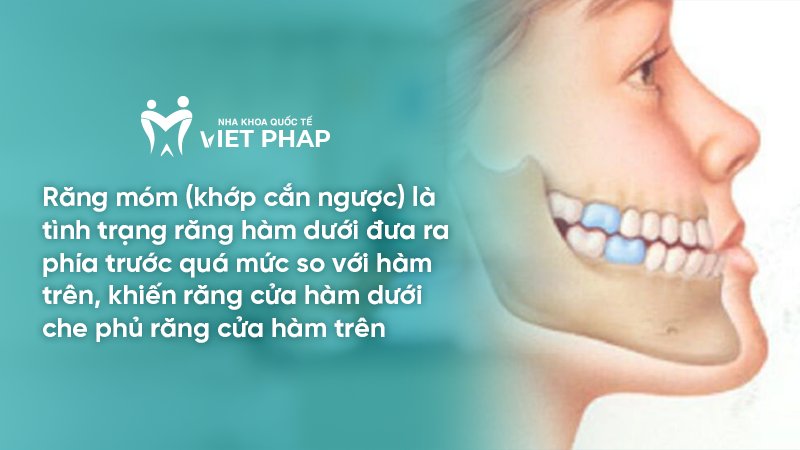 rang mom 1 Răng móm (khớp cắn ngược) là tình trạng răng hàm dưới đưa ra phía trước quá mức so với hàm trên, khiến răng cửa hàm dưới che phủ răng cửa hàm trên