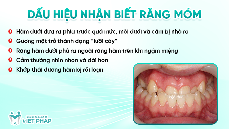 rang mom 2 Dấu hiệu nhận biết răng móm
