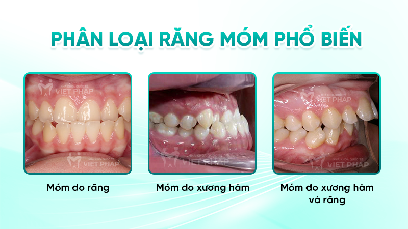 rang mom 3 Phân loại răng móm phổ biến