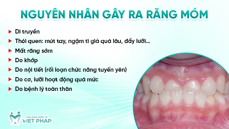 rang mom 4 Nguyên nhân gây ra răng móm