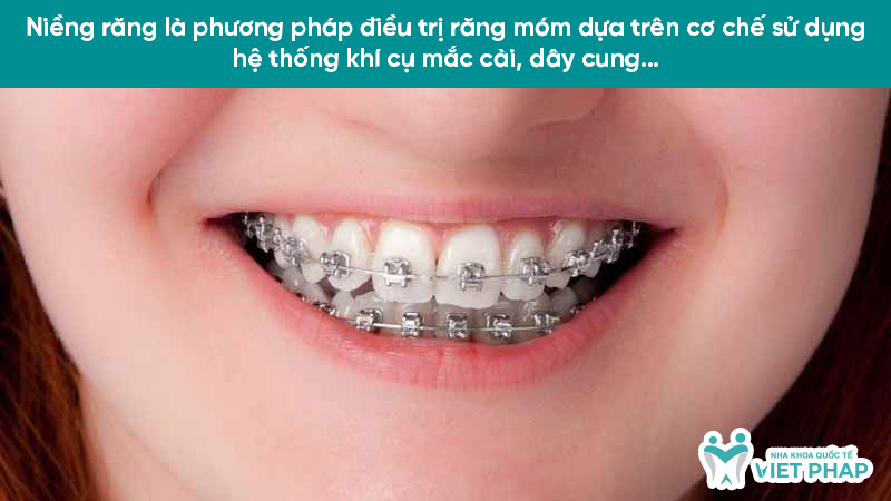 rang mom 6.2 Niềng răng là phương pháp điều trị răng móm dựa trên cơ chế sử dụng hệ thống khí cụ mắc cài, dây cung…