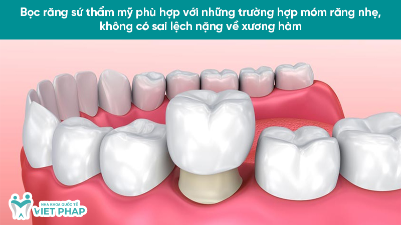 rang mom 6.3 Bọc răng sứ thẩm mỹ phù hợp với những trường hợp móm răng nhẹ, không có sai lệch nặng về xương hàm