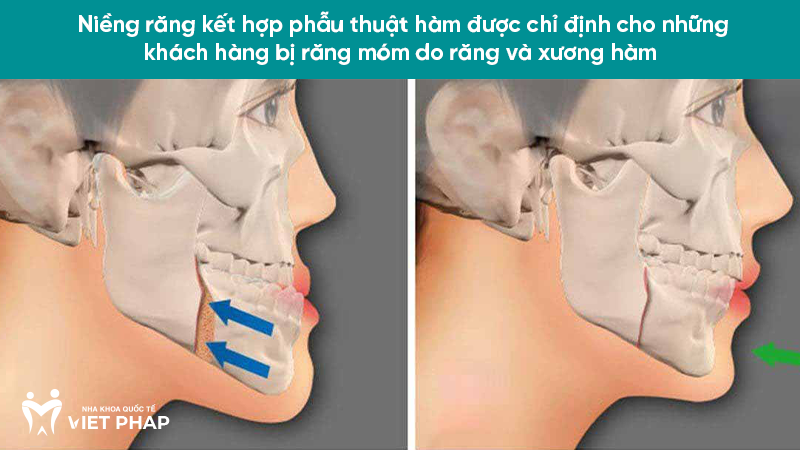 rang mom 6.5 Niềng răng kết hợp phẫu thuật hàm được chỉ định cho những khách hàng bị răng móm do răng và xương hàm