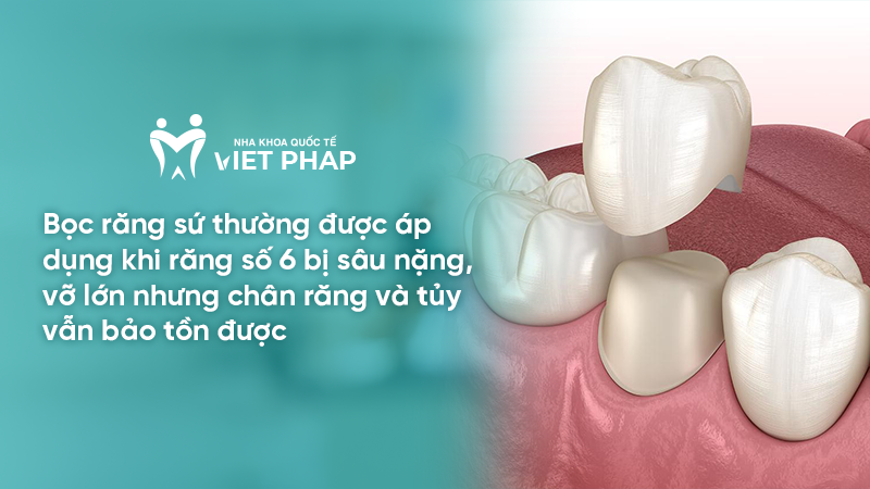 Bọc răng sứ thường được áp dụng khi răng số 6 bị sâu nặng, vỡ lớn nhưng chân răng và tủy vẫn bảo tồn được