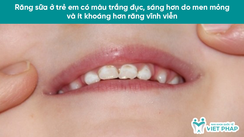 Răng sữa ở trẻ em có màu trắng đục, sáng hơn do men mỏng và ít khoáng hơn răng vĩnh viễn
