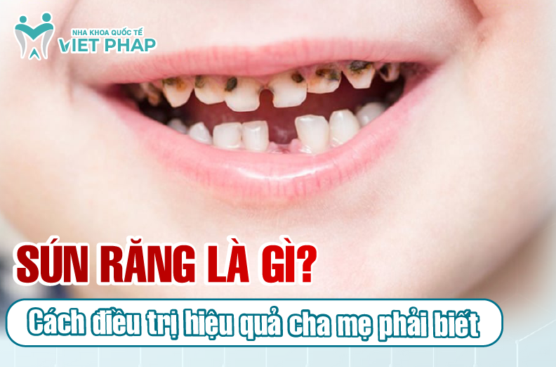 Sún răng là gì? Sâu răng và sún răng ở trẻ khác gì? Cách điều trị hiệu ...