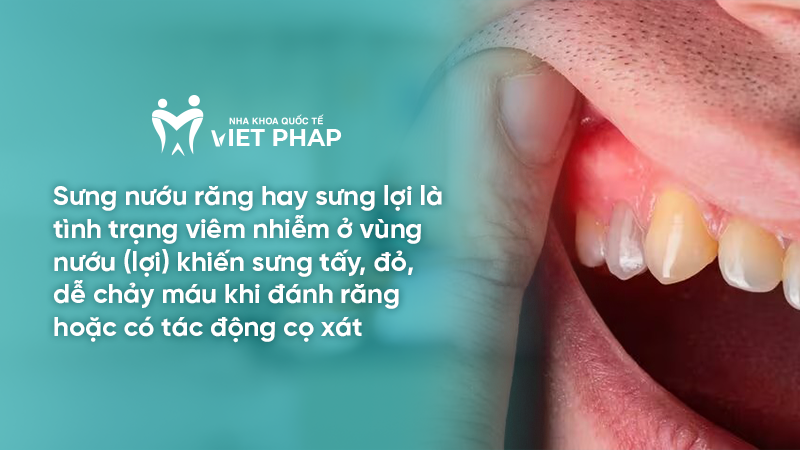 sung nuou rang 1 Sưng nướu răng hay sưng lợi là tình trạng viêm nhiễm ở vùng nướu (lợi) khiến sưng tấy, đỏ, dễ chảy máu khi đánh răng hoặc có tác động cọ xát