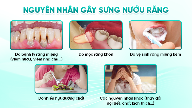 sung nuou rang 3.2 Nguyên nhân gây sưng nướu răng
