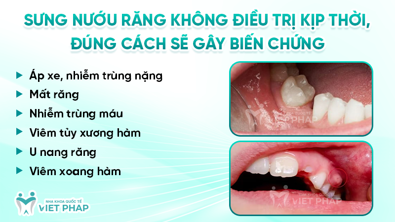sung nuou rang 4 Sưng nướu răng không điều trị kịp thời, đúng cách sẽ gây biến chứng