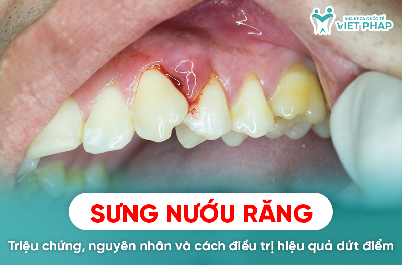 Sưng nướu răng - Triệu chứng, nguyên nhân và cách điều trị hiệu quả dứt ...