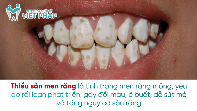 Thiểu sản men răng là tình trạng men răng mỏng, yếu do rối loạn phát triển, gây đổi màu, ê buốt, dễ sứt mẻ và tăng nguy cơ sâu răng