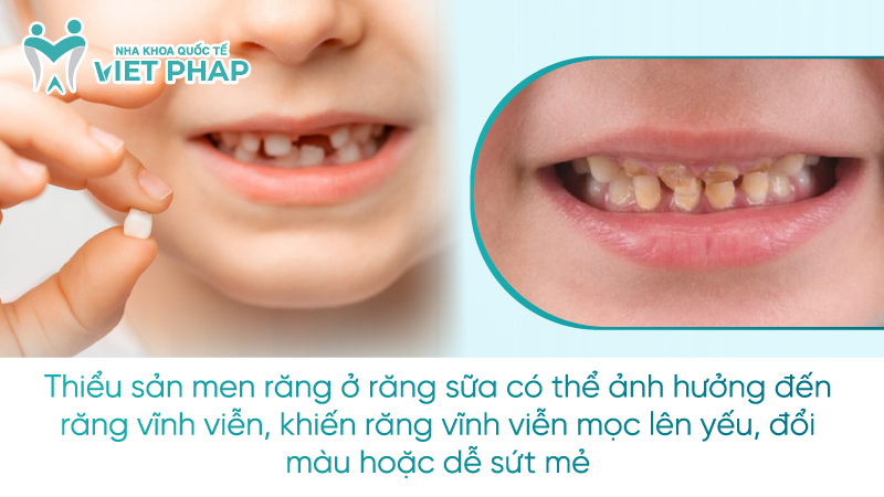 Thiểu sản men răng ở răng sữa có thể ảnh hưởng đến răng vĩnh viễn, khiến răng vĩnh viễn mọc lên yếu, đổi màu hoặc dễ sứt mẻ