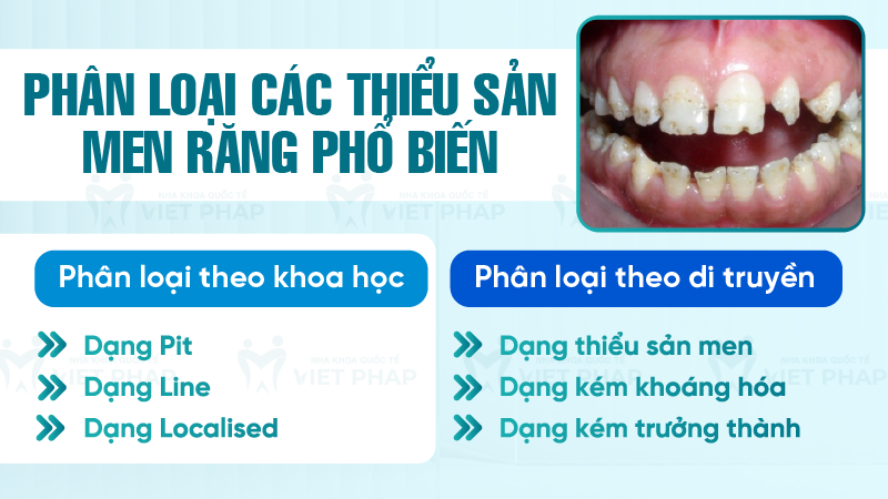 Phân loại các thiểu sản men răng phổ biến