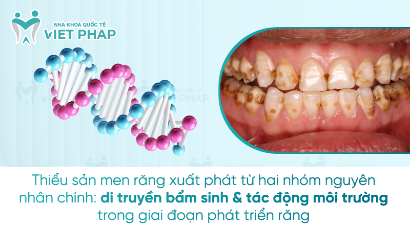 Thiểu sản men răng xuất phát từ hai nhóm nguyên nhân chính: di truyền bẩm sinh & tác động môi trường trong giai đoạn phát triển răng