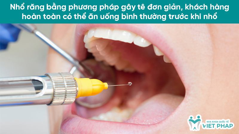 Nhổ răng bằng phương pháp gây tê đơn giản, khách hàng hoàn toàn có thể ăn uống bình thường trước khi nhổ