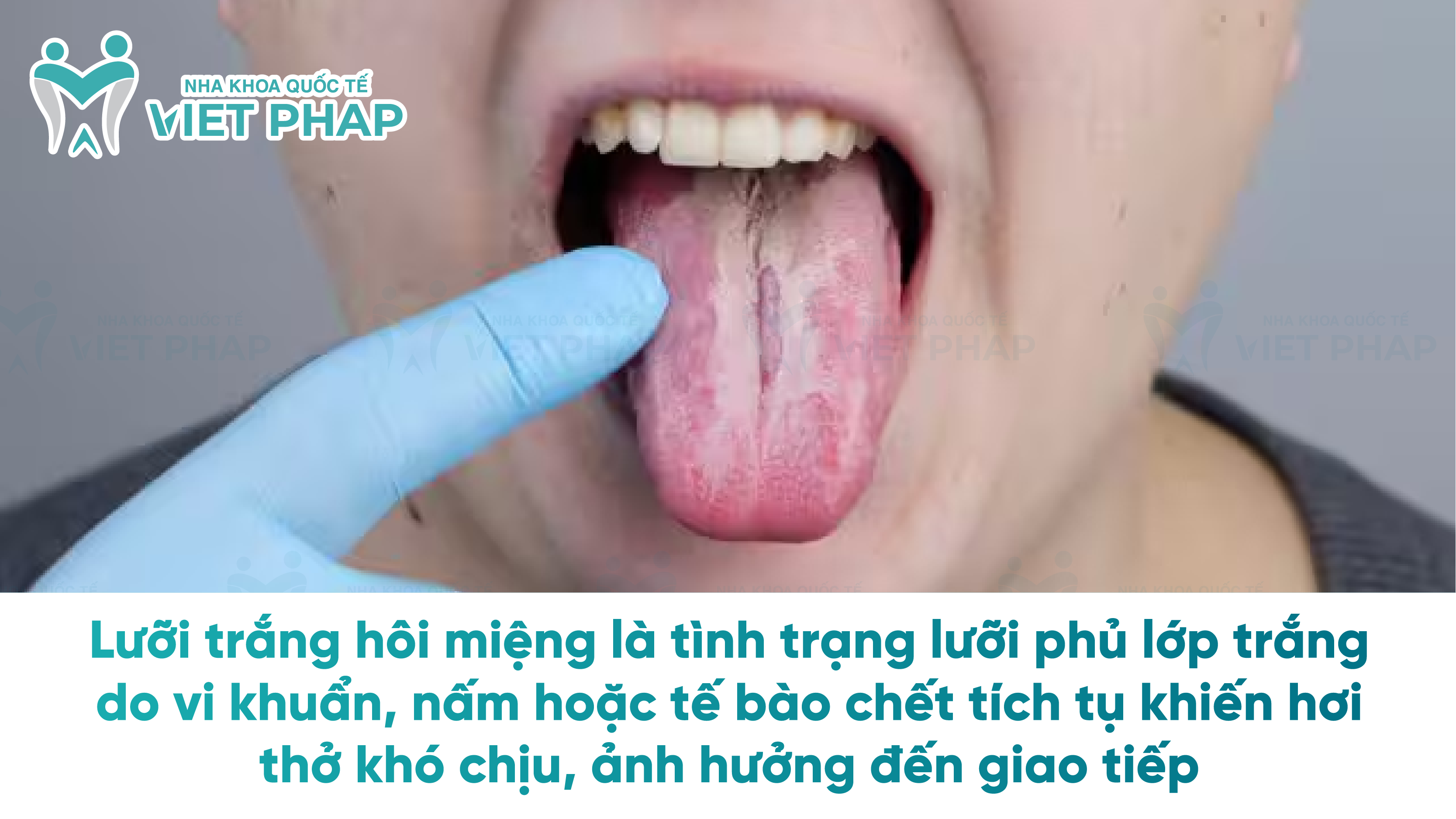 Lưỡi trắng hôi miệng là tình trạng lưỡi phủ lớp trắng do vi khuẩn, nấm hoặc tế bào chết tích tụ khiến hơi thở khó chịu, ảnh hưởng đến giao tiếp