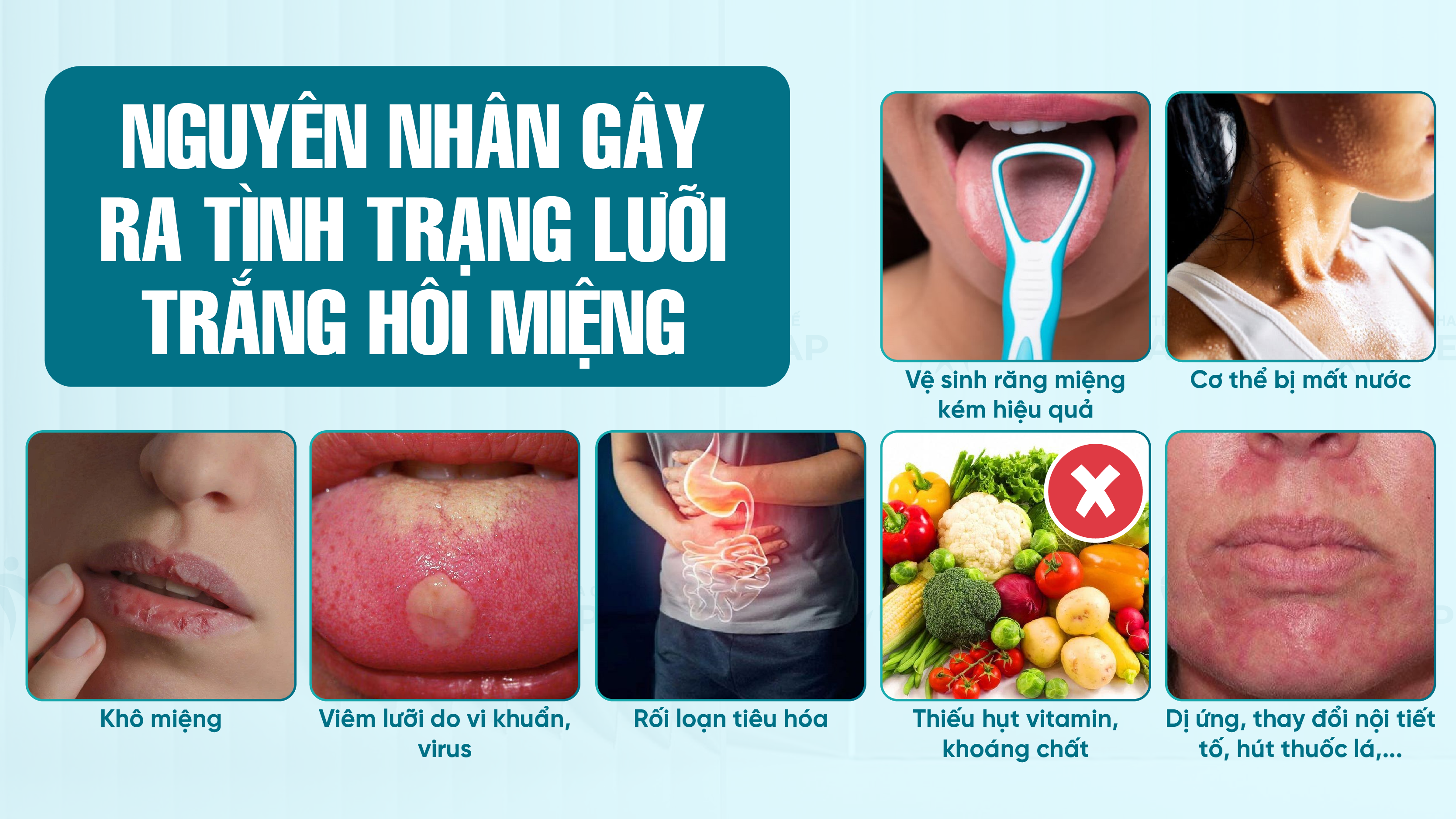 Nguyên nhân gây ra tình trạng lưỡi trắng hôi miệng