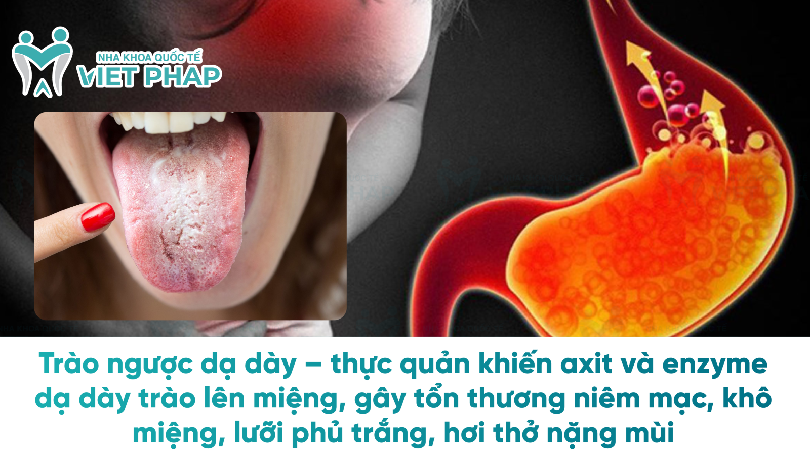 Trào ngược dạ dày – thực quản khiến axit và enzyme dạ dày trào lên miệng, gây tổn thương niêm mạc, khô miệng, lưỡi phủ trắng, hơi thở nặng mùi