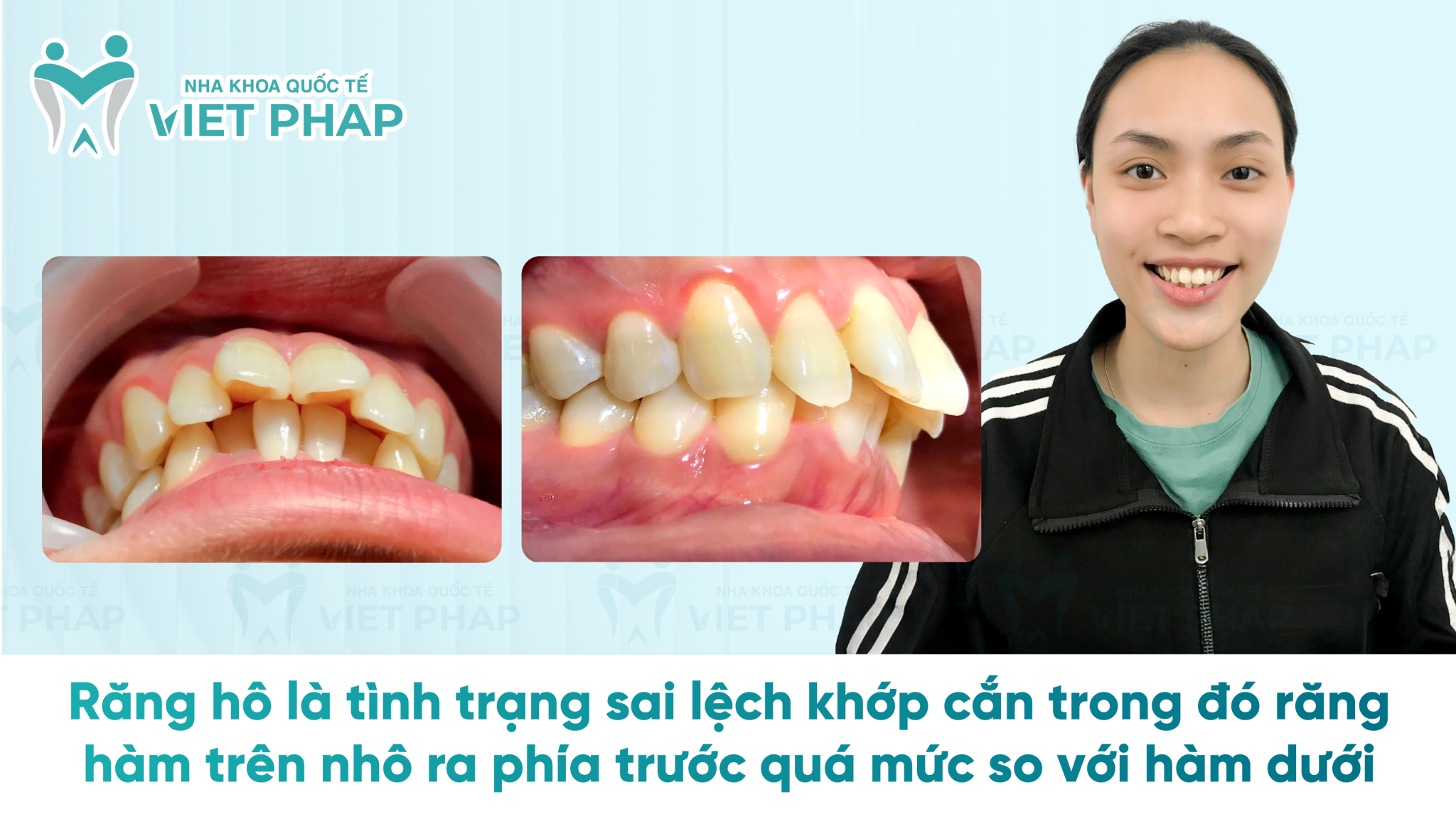 Ho Rang Ho Rang Răng hô là gì? - Các kiểu hô, tác hại và phương pháp điều trị hiệu quả ...