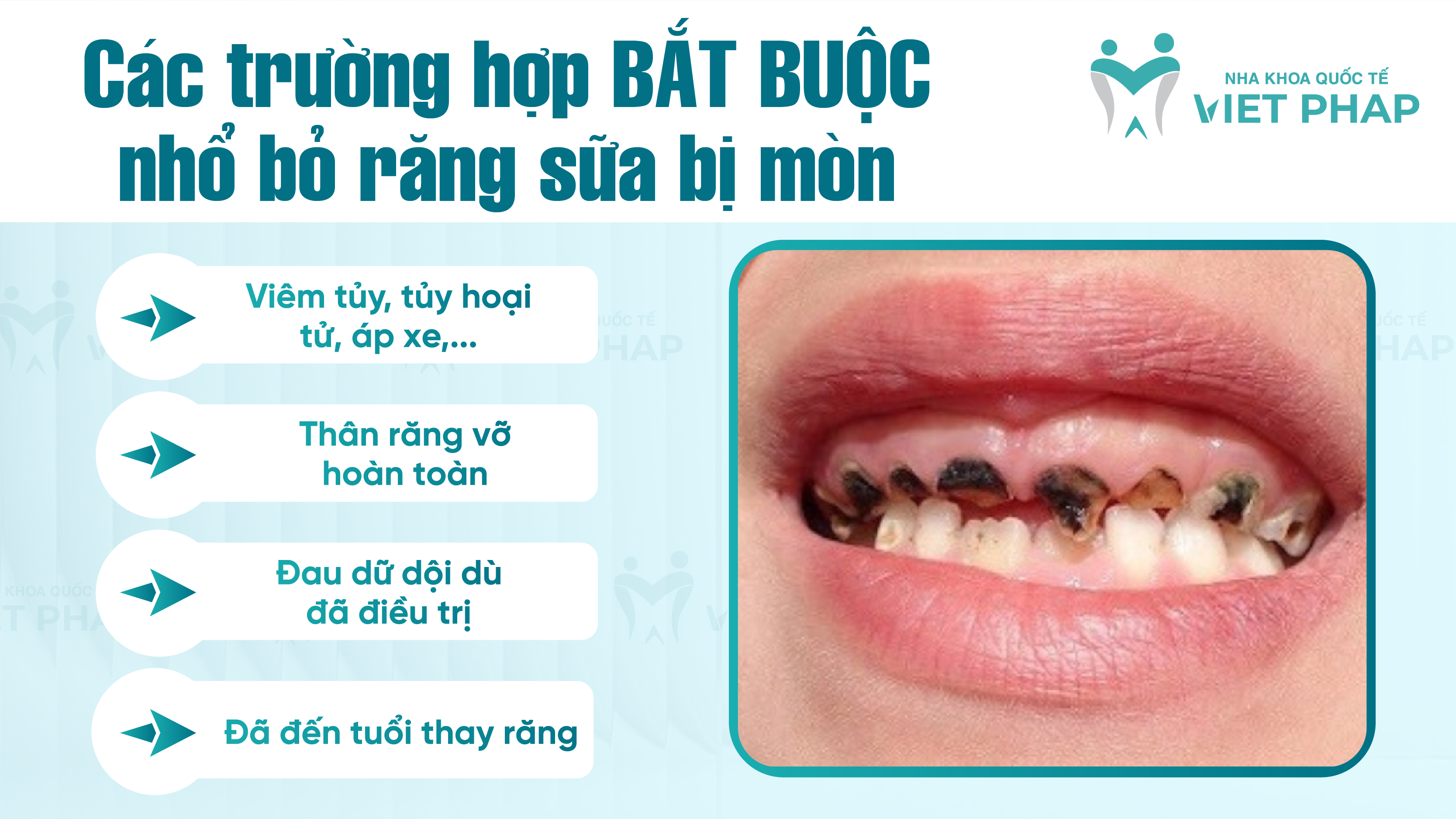Các trường hợp BẮT BUỘC nhổ bỏ răng sữa bị mòn