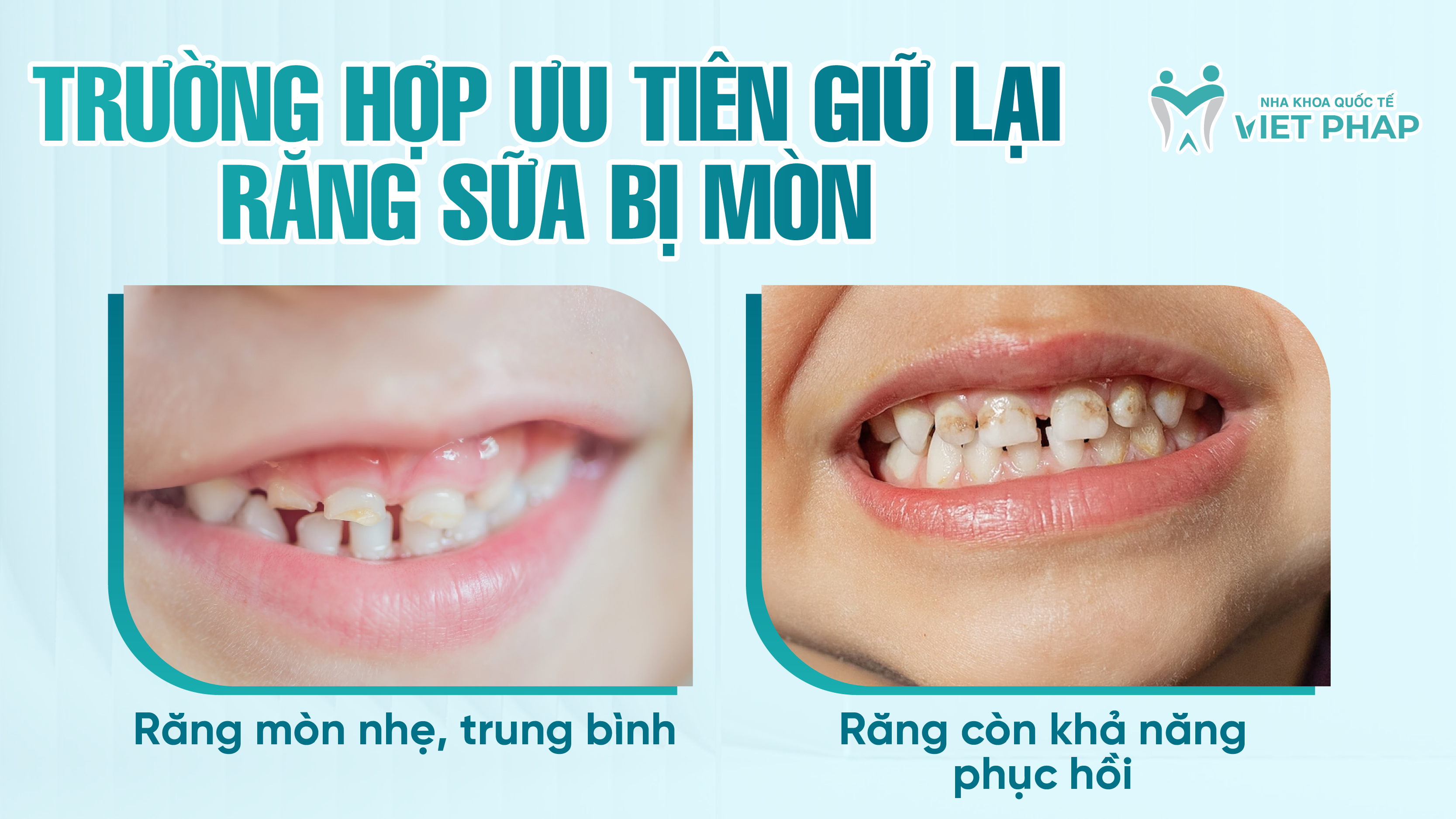 Trường hợp ƯU TIÊN giữ lại răng sữa bị mòn