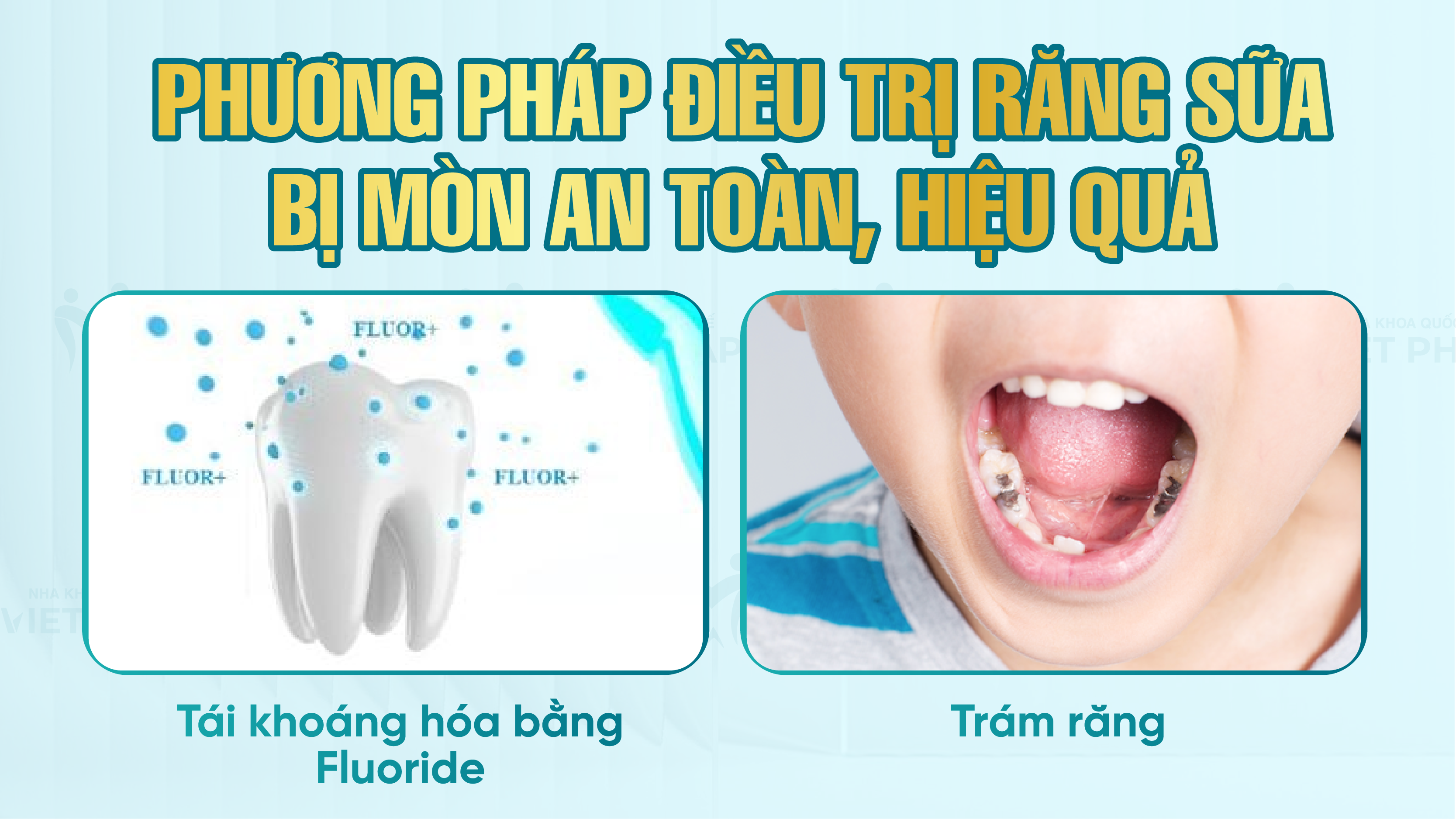 Phương pháp điều trị răng sữa bị mòn an toàn, hiệu quả