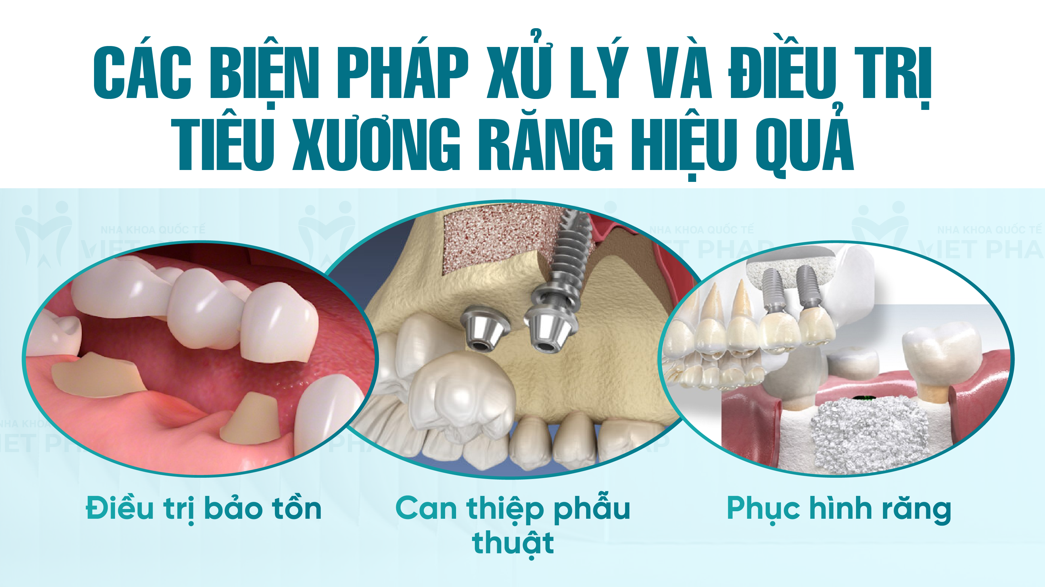 Tieu xuong rang co chua duoc khong 4 Các biện pháp xử lý và điều trị tiêu xương răng hiệu quả