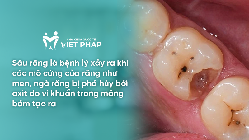 Sâu răng là bệnh lý xảy ra khi các mô cứng của răng như men, ngà răng bị phá hủy bởi axit do vi khuẩn trong mảng bám tạo ra