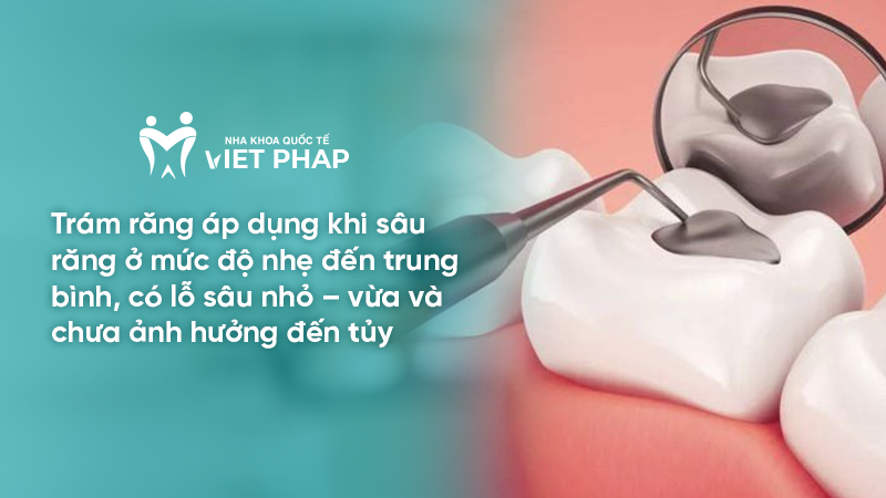 Trám răng áp dụng khi sâu răng ở mức độ nhẹ đến trung bình, có lỗ sâu nhỏ – vừa và chưa ảnh hưởng đến tủy
