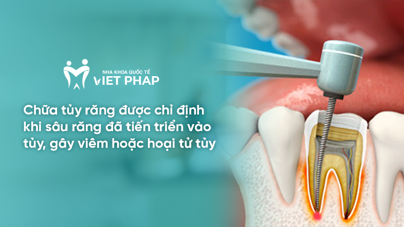 Chữa tủy răng được chỉ định khi sâu răng đã tiến triển vào tủy, gây viêm hoặc hoại tử tủy