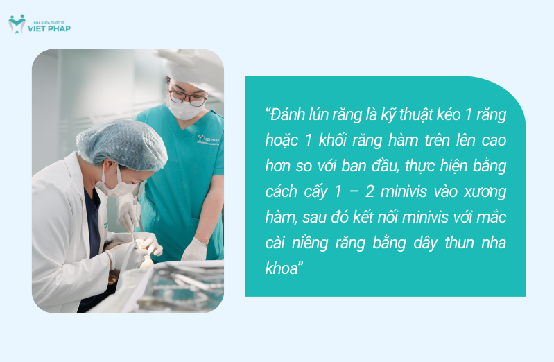 danh lun rang la gi 1 Đánh lún răng là kỹ thuật kéo 1 răng hoặc 1 khối răng hàm trên lên cao hơn so với ban đầu