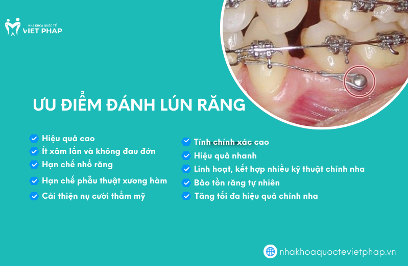 danh lun rang la gi 2 Ưu điểm đánh lún răng