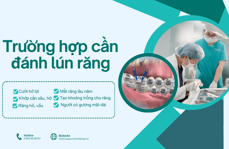 danh lun rang la gi 4 Trường hợp cần thực hiện đánh lún răng
