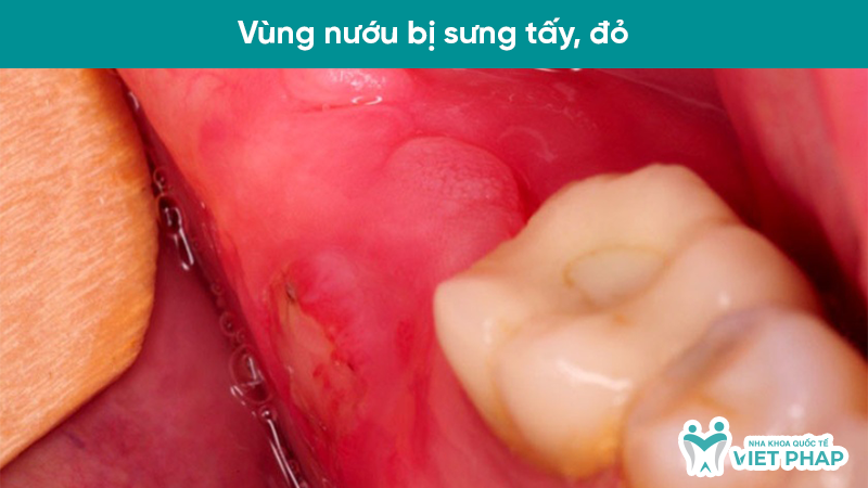 Vùng nướu bị sưng tấy, đỏ