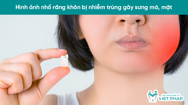 Hình ảnh nhổ răng khôn bị nhiễm trùng gây sưng má, mặt
