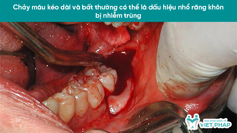 Chảy máu kéo dài và bất thường có thể là dấu hiệu nhổ răng khôn bị nhiễm trùng